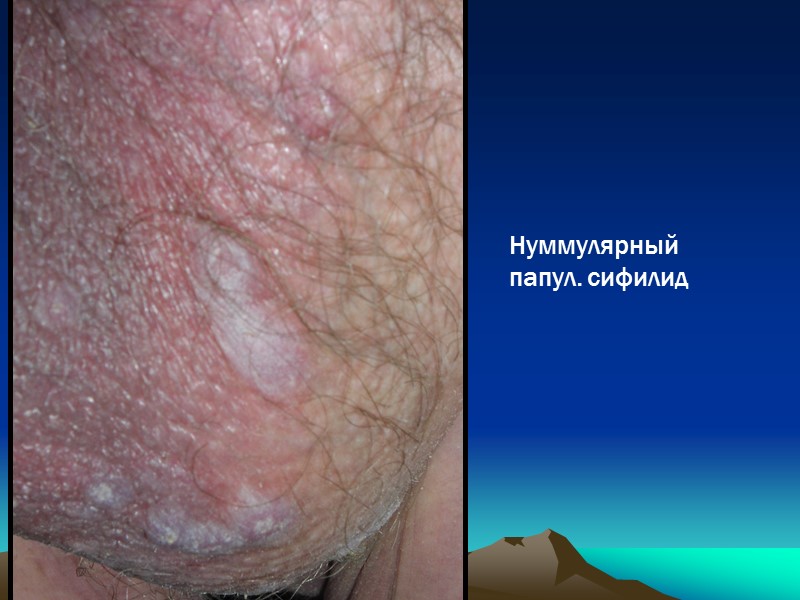 Нуммулярный папул. сифилид